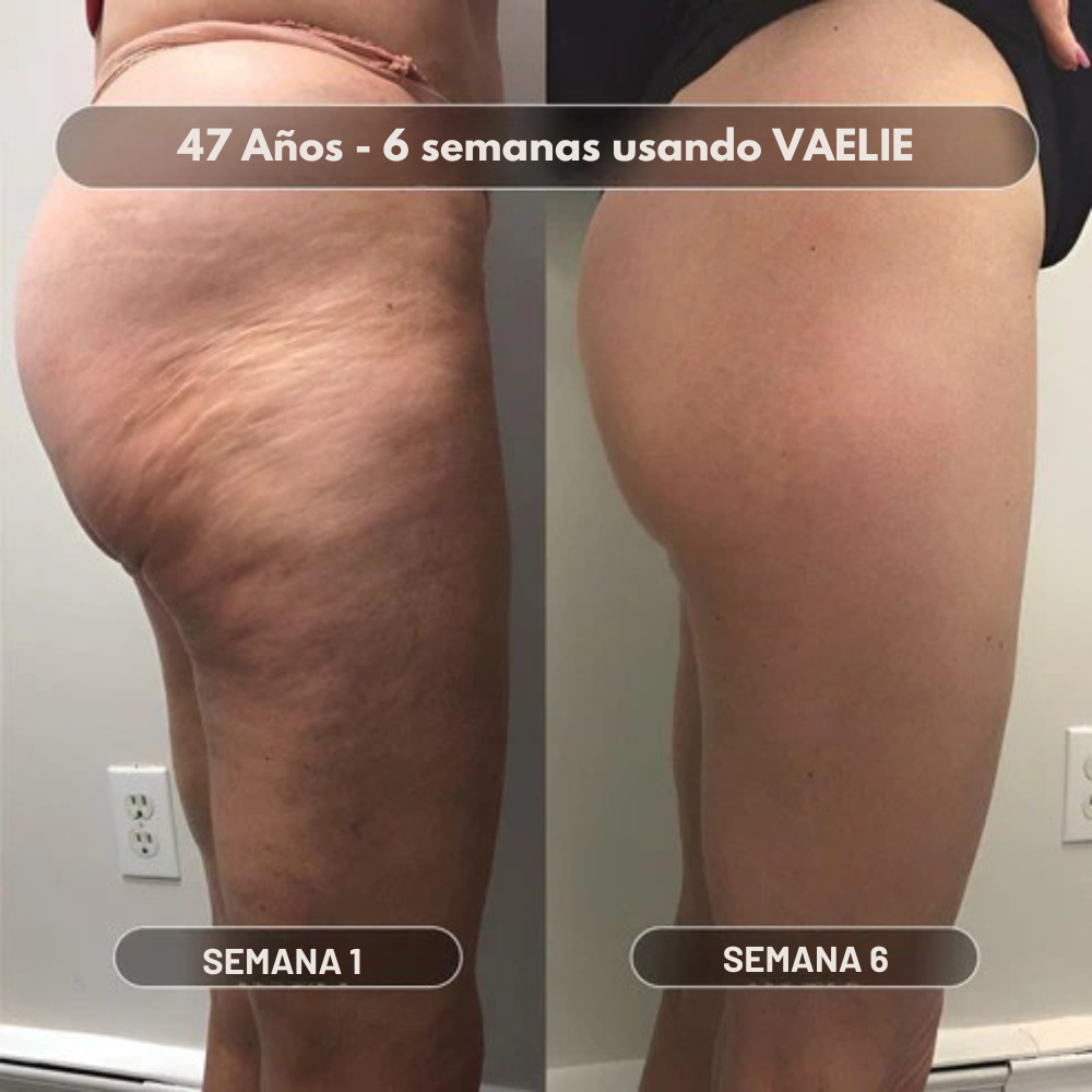 Vaelie Aceite Corporal Anti-Celulitis™